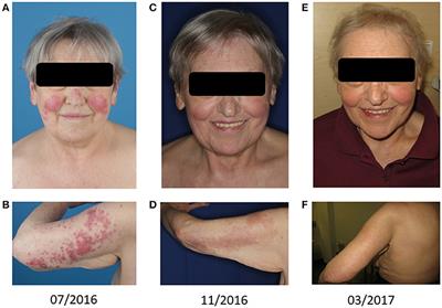 Cutaneous Leukemic Infiltrates Successfully Treated With Biomodulatory Therapy in a Rare Case of Therapy-Related High Risk MDS/AML